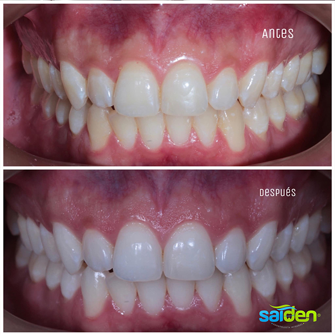 Servicio implantes dentales