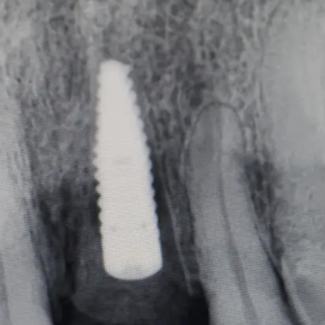 Servicio resinas dentales